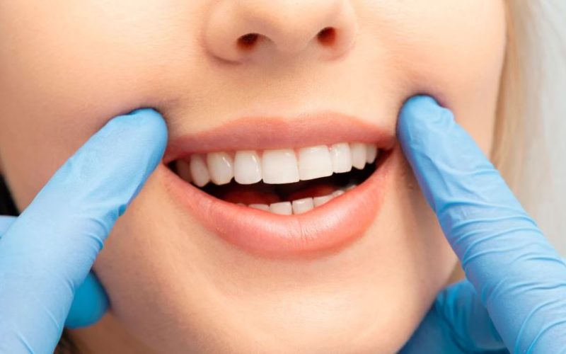 Why More Patients Are Choosing Composite Bonding & How to Get Started?